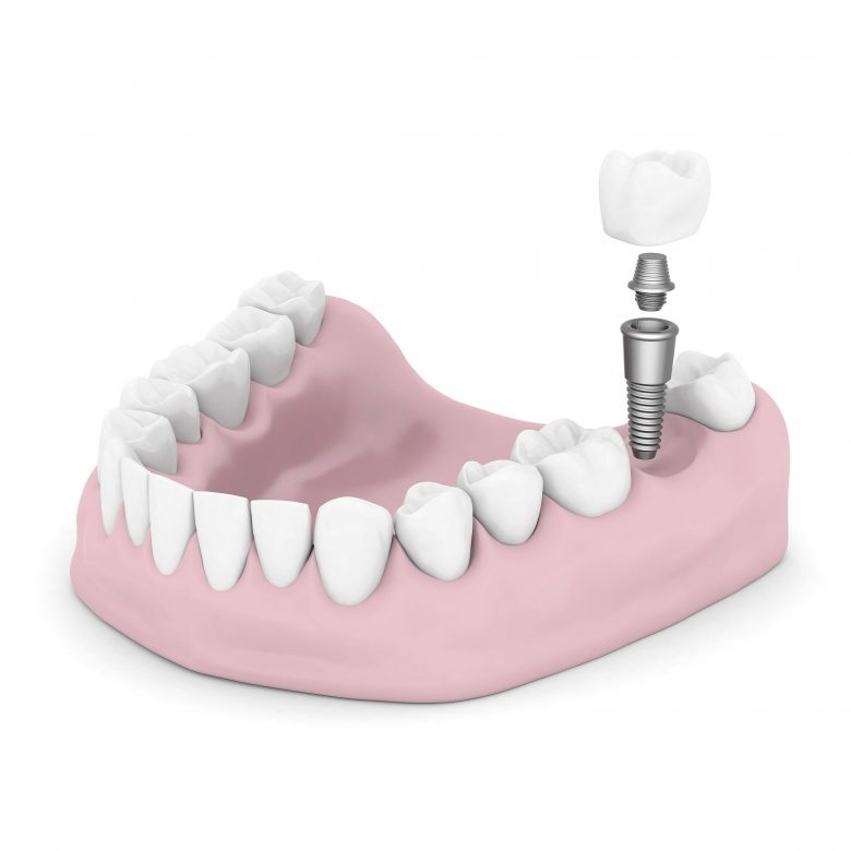 Valley Stream Dental Implants Contemporary Dental Implant Centre